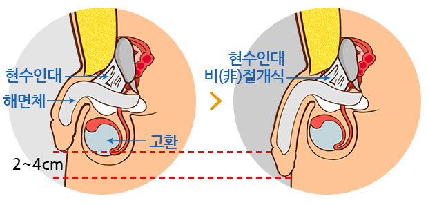 하이맨 자라고추교정 길이연장술