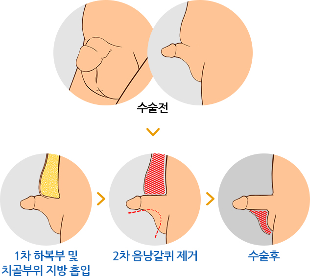 1차 하복부 및 치골부위 지방 흡입 / 2차 음낭갈퀴 제거 / 수술후 