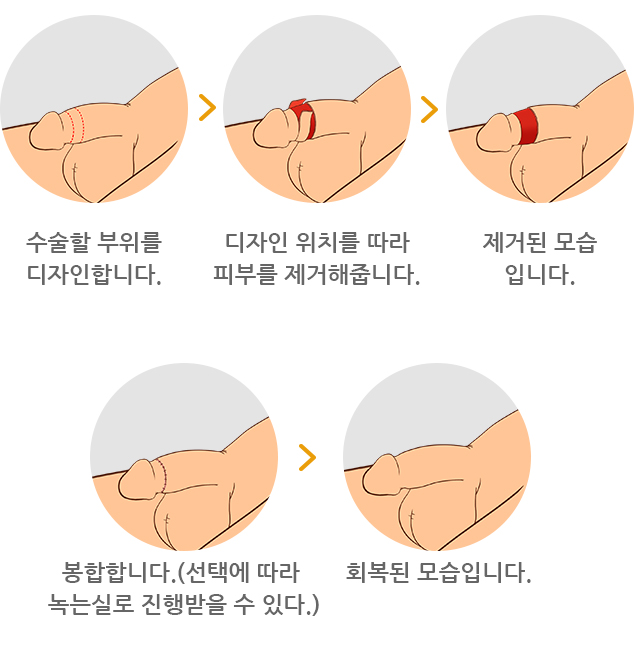 기존레이저포경수술