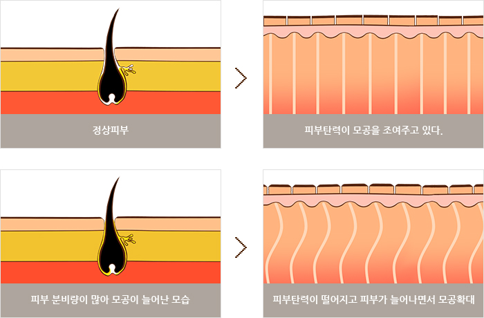 노화